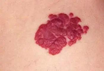 脑血管瘤破溃结痂后会自愈吗,血管瘤破溃怎么办