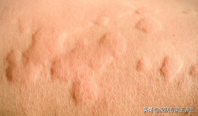 麻疹初期会出现皮肤痒吗,麻疹是不是有痒有疼