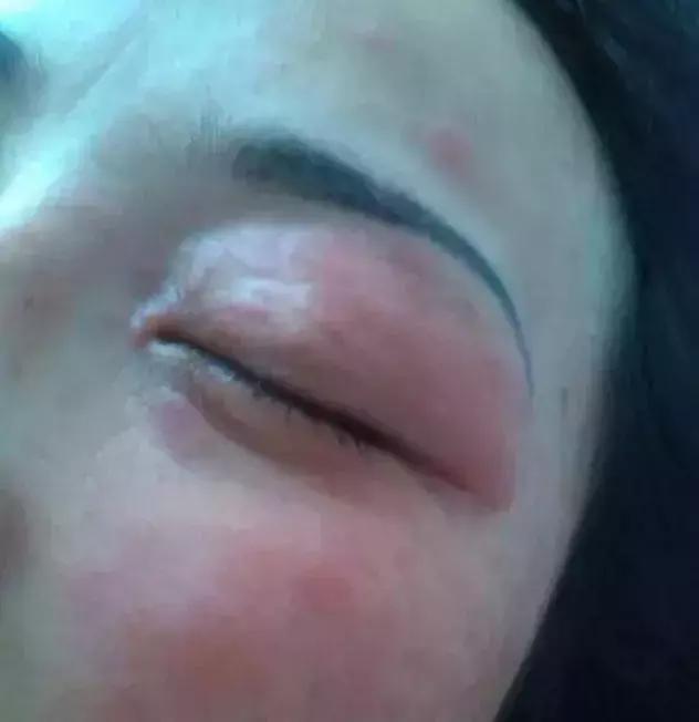 皮肤化妆品过敏最快缓解方法,皮肤过敏一定是化妆品的错吗