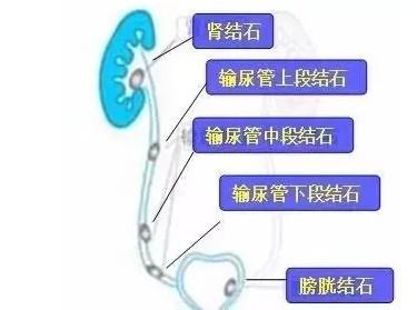 医生说肾里有结石不要紧,有结石为什么彩超照不出来
