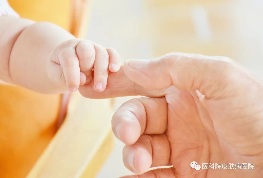 孩子得了银屑病怎么办,孩子银屑病能用激素药吗