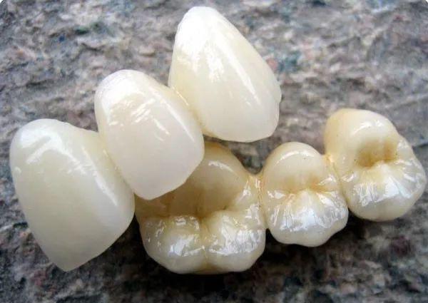 二氧化锆假牙可以做核磁吗,拿不掉的假牙可以做核磁共振么