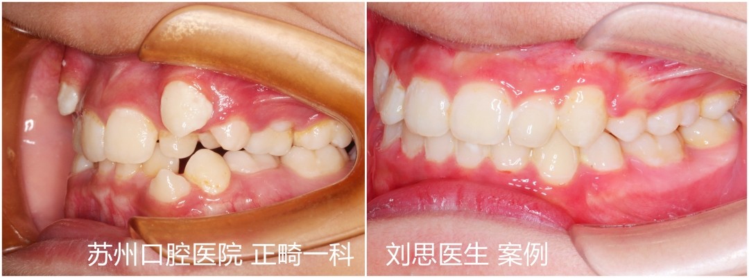 成人矫正期间牙齿松动正常吗,成年人牙齿矫正会松动吗