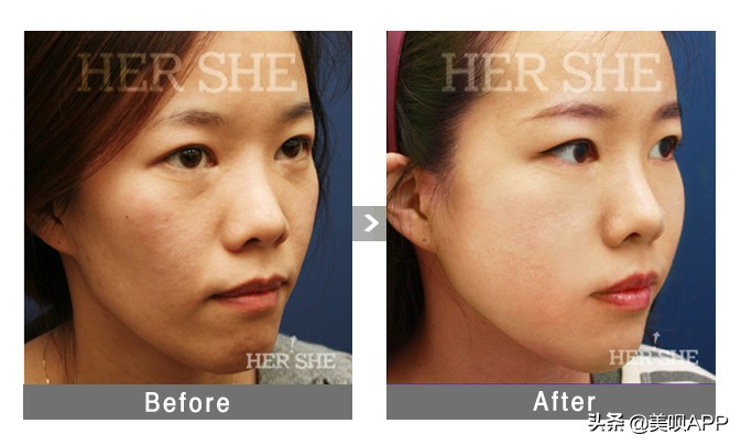 西京医院整形美容科面部年轻化,面部美容年轻化手术科普