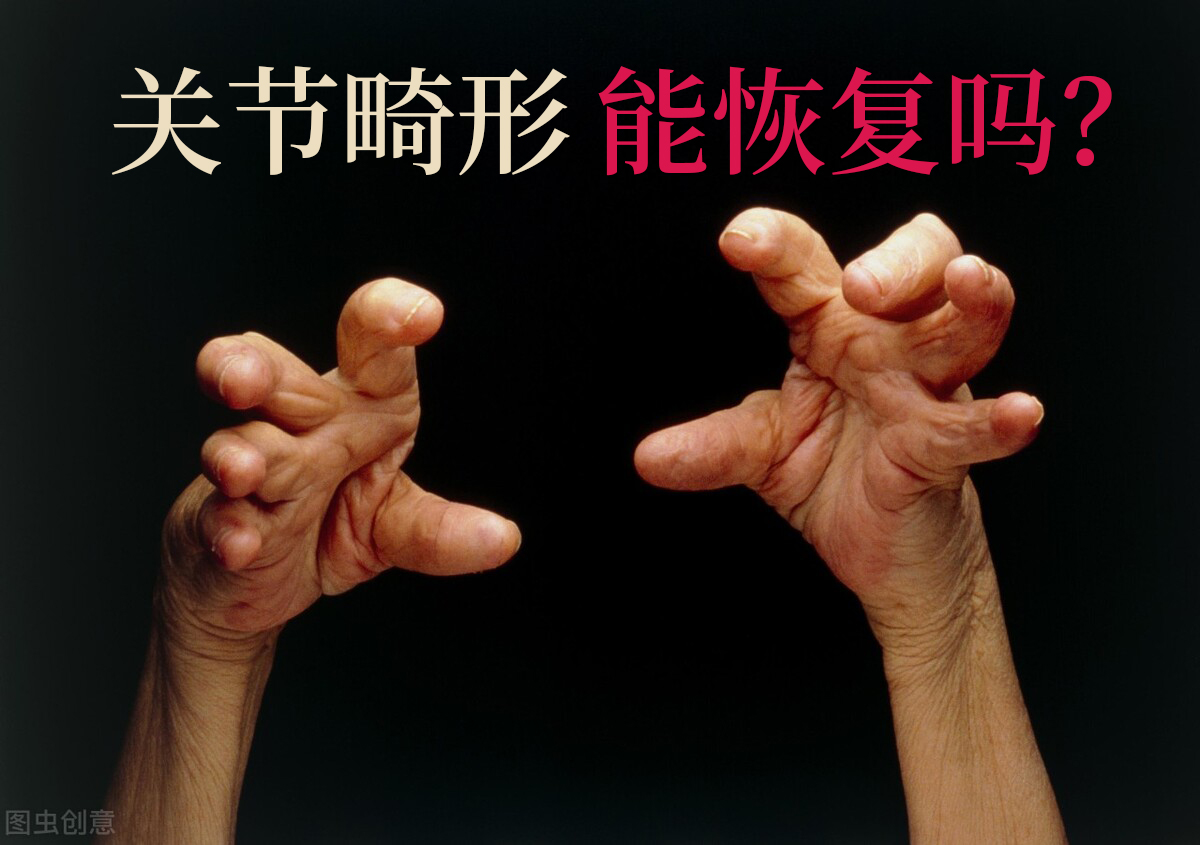 骨关节炎痛风和类风湿都有何症状,痛风关节严重畸形患者能活多久