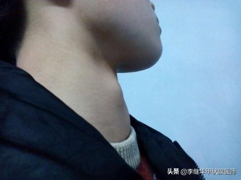 桥本甲状腺炎和甲减的恩怨,甲状腺与碘的恩怨