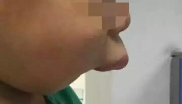 小黑点的蛀牙不严重吗,蛀牙了一点点黑色也得补么