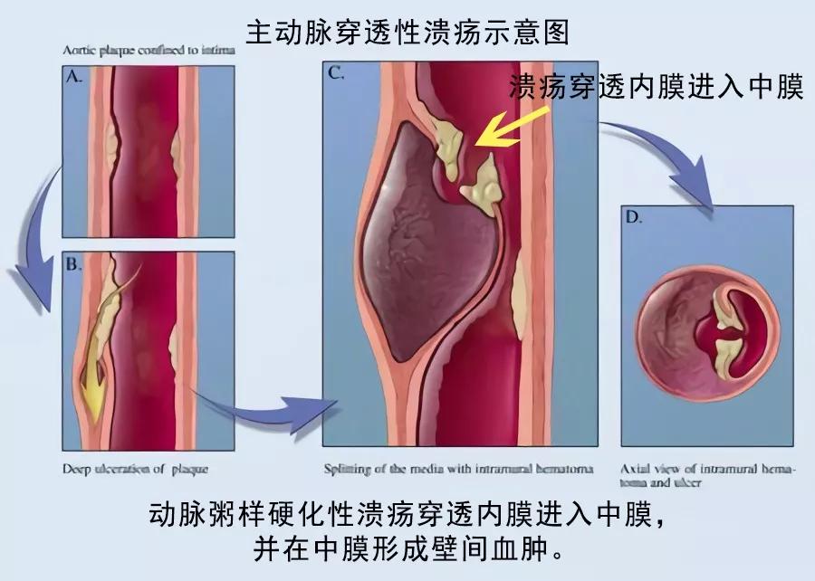 主动脉夹层需要和哪些疾病相鉴别,急性主动脉夹层是什么病怎么治