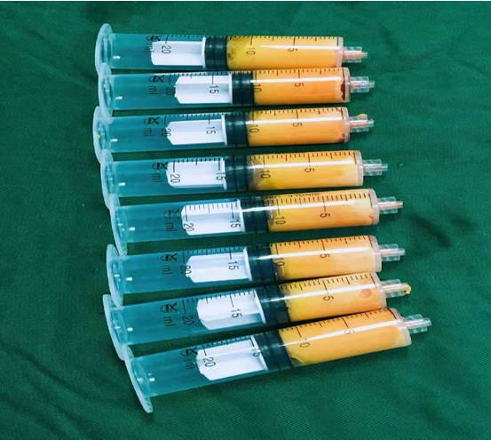 脂肪胶填充好还是自体填充好,纳米脂肪胶和自体脂肪的区别