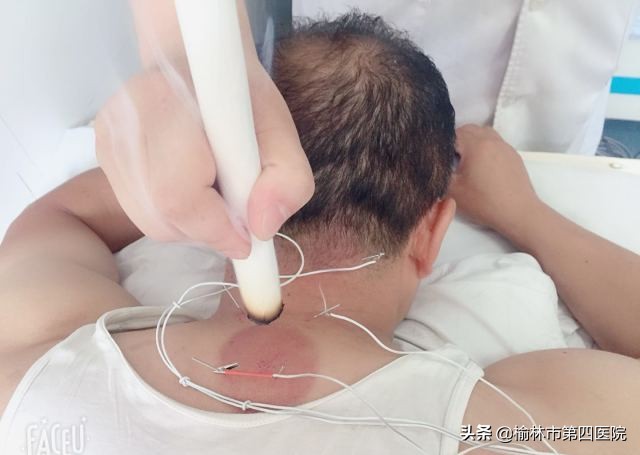 榆林市星元医院“冬病夏治”贴敷治疗项目正式启动