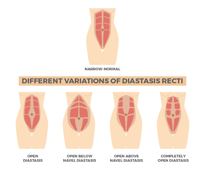 腹肌撕裂和腹直肌分离,腹肌撕裂者腹直肌分离