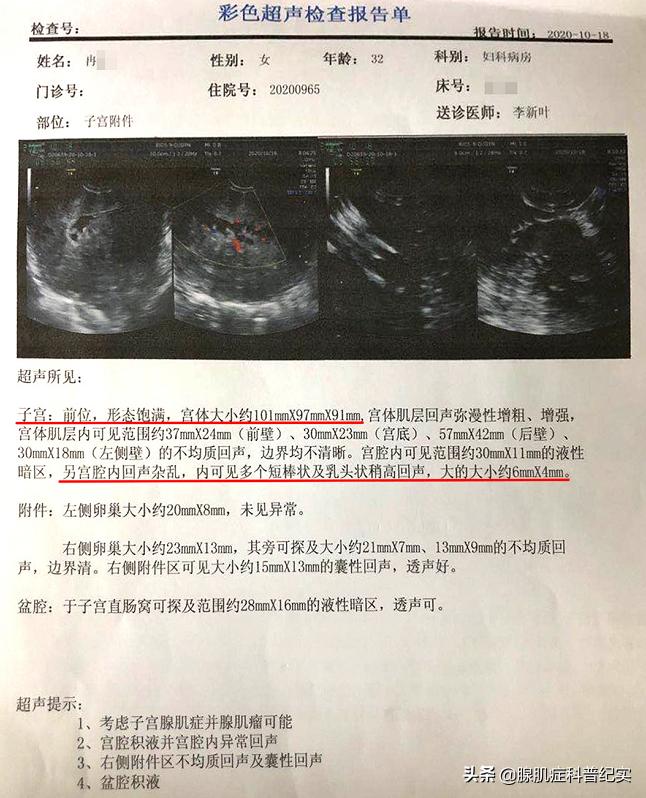 腺肌症诊刮后一直出血,腺肌症自救