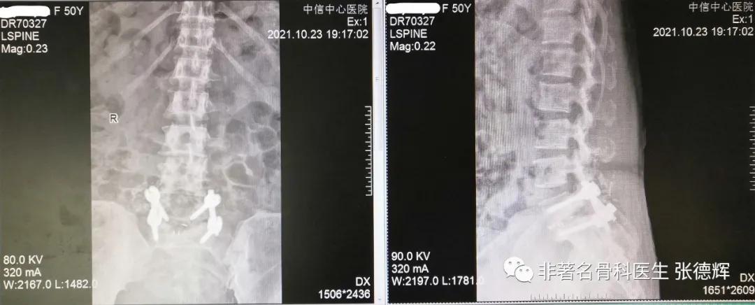 腰椎真性滑脱,手术复位融合固定