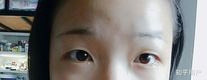 韩慧景整容事件原因,韩慧景是怎么整容失败的