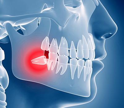 智齿拔除后怎么处理智齿,智齿有必要拔吗智齿痛怎么办