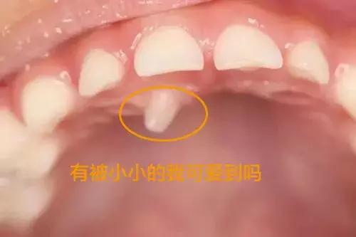 孩子喜欢打闹招惹别人怎么办,儿童埋伏多生牙
