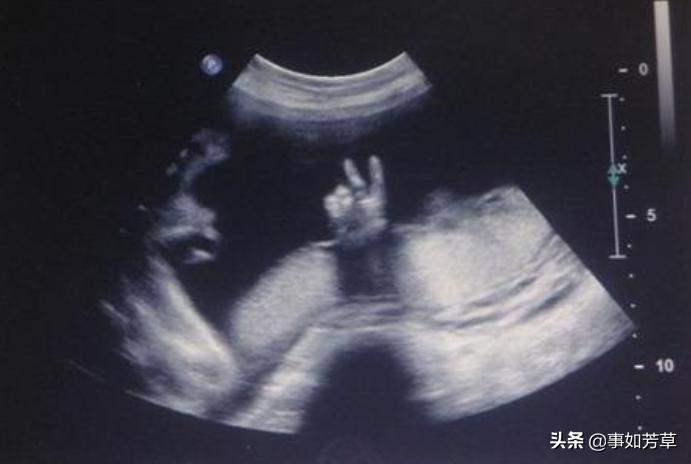胎儿分娩时仅36周，宝妈怀疑宝宝抓破孕肚，医生：不是这么回事