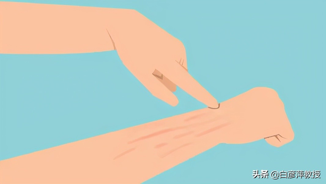 轻轻一划皮肤就会出现红痕,划皮肤出现红色印子是划痕症吗