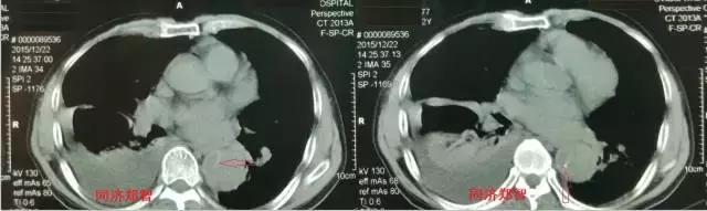 磁共振可以替代cta检查主动脉夹层,超声心动图联合cta诊断主动脉夹层