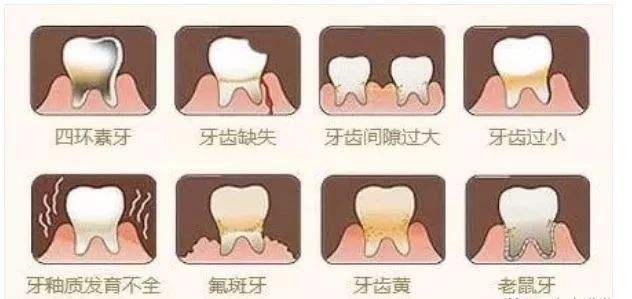 牙齿美白全瓷贴面可以矫正么,牙齿贴面修复龅牙