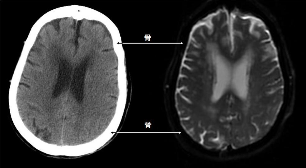 磁共振cta影像检查科普,ct照片和核磁共振的区别