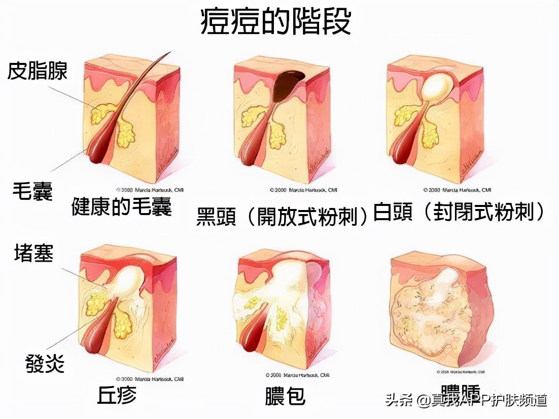 毛孔粗大黑头多简单四步轻松搞定,毛孔粗大有黑头适合用什么洗面奶