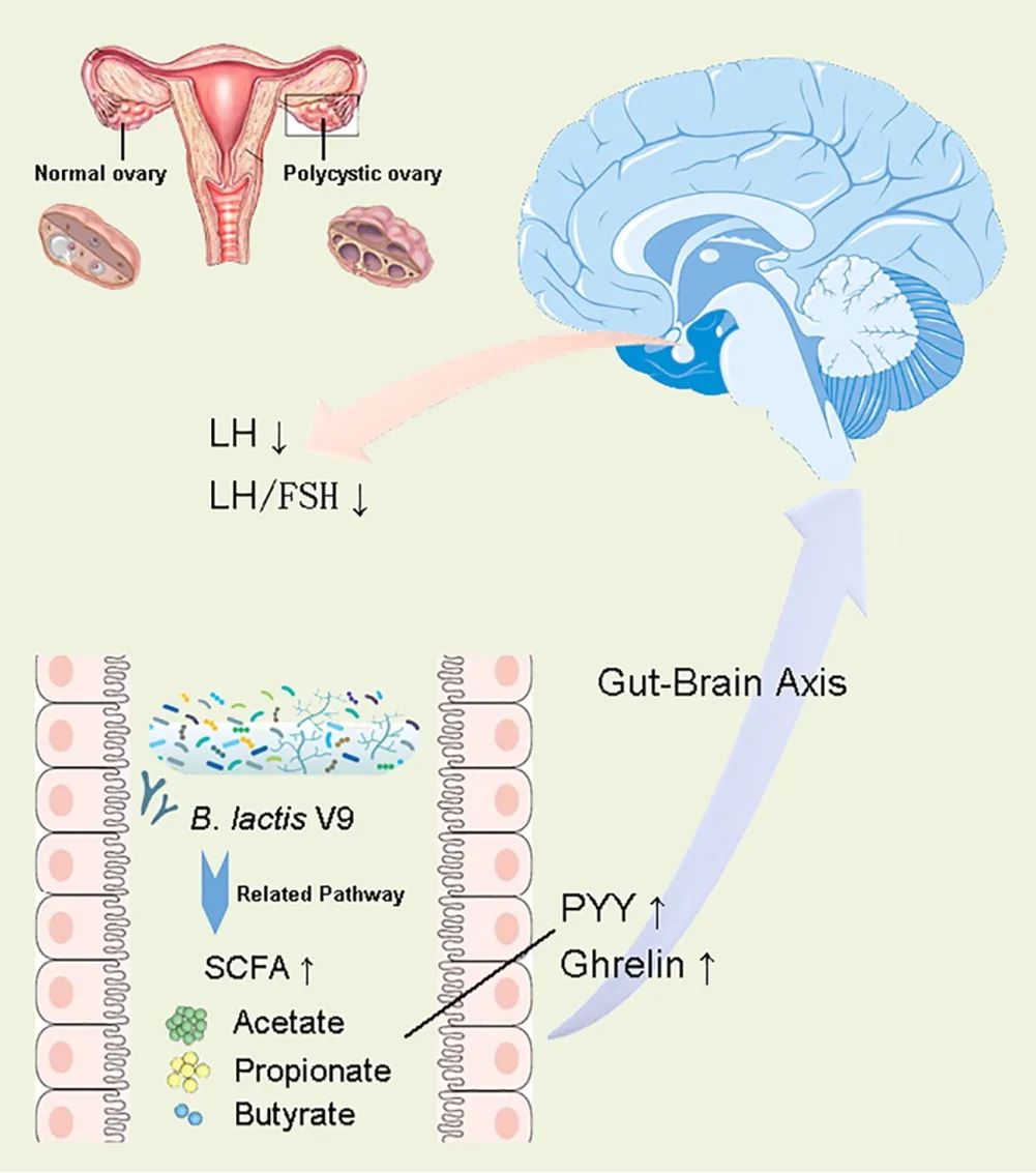 肠道菌群移植治疗肠道易激综合征,多囊卵巢综合征与肠道菌群紊乱