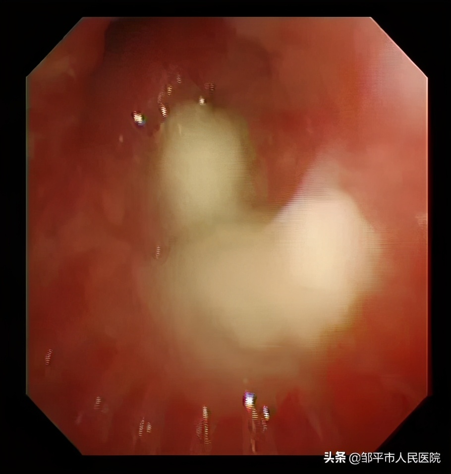 重症肺炎最佳治疗方法,满月宝宝重症肺炎如何治疗