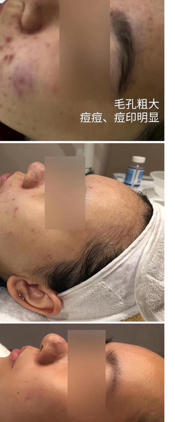 今天治疗,明天上班,激光中的“法拉利”超皮秒