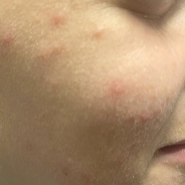 十年战痘肌自救指南,十年痘肌怎么抗痘