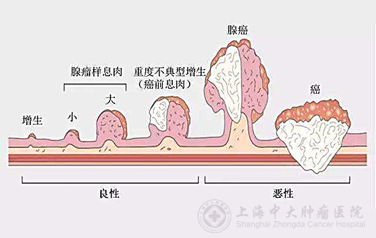 胃息肉和胃癌在胃镜下的区别,胃息肉容易变癌吗