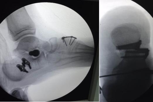 中年人扁平足做微创手术,僵硬型扁平足手术