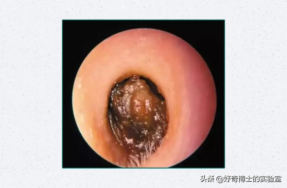 看看8年没有掏耳屎是什么样子,十年不掏耳屎你耳朵有多脏
