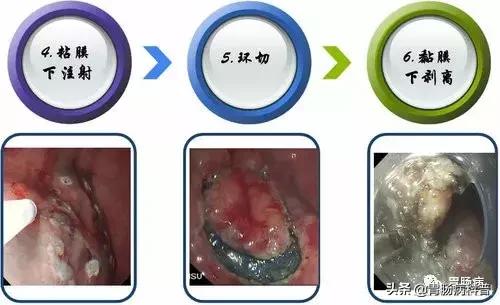 内镜下粘膜剥离术属于esd还是emr,胃肠息肉内镜下黏膜剥离术