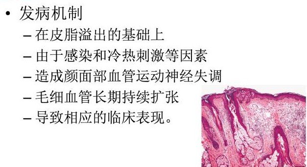 酒渣鼻有什么特效药,酒渣鼻的原因及治疗