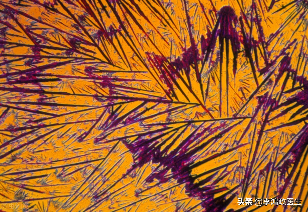 女性臀部反复长疙瘩,屁股肉疙瘩手术治疗全过程