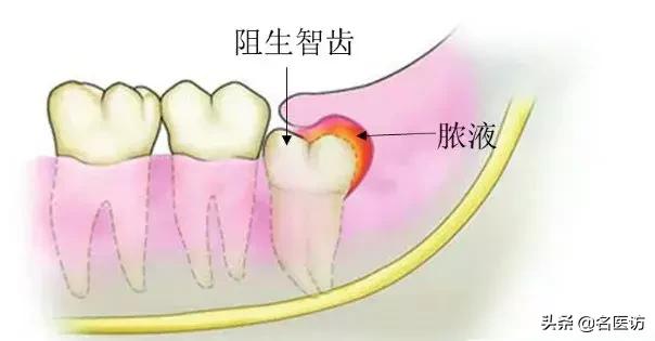 拔智齿有什么禁忌吗,拔智齿有什么禁忌