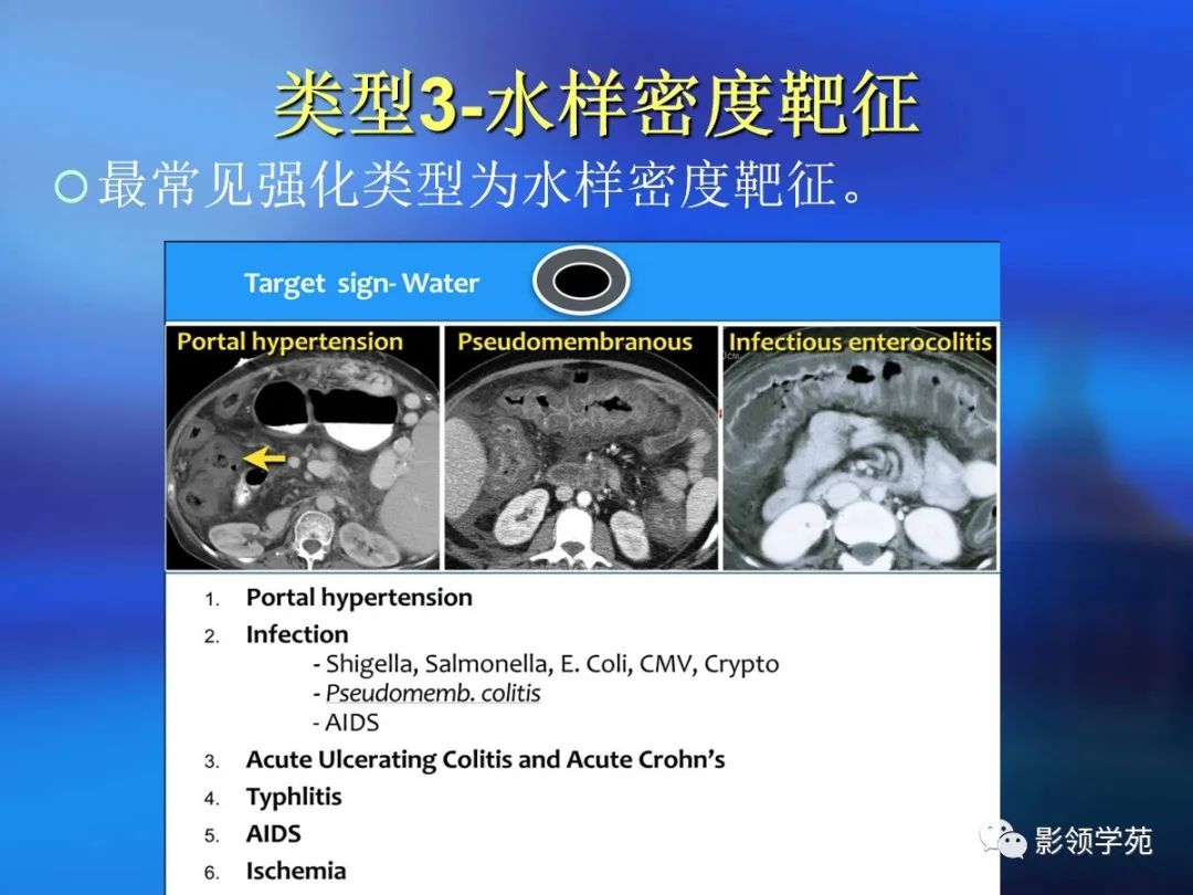 肠道内壁增厚,肠道扩张ct表现
