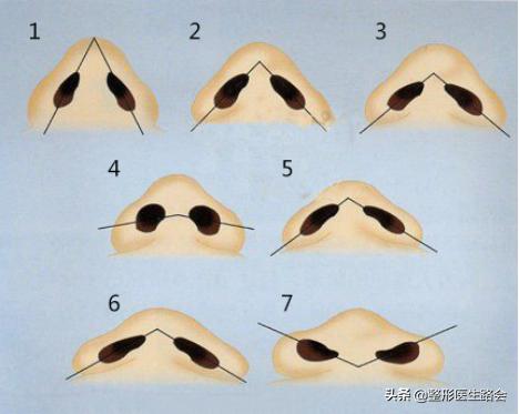 鼻头变大如何修复,鼻修复半年了鼻头变大怎么办