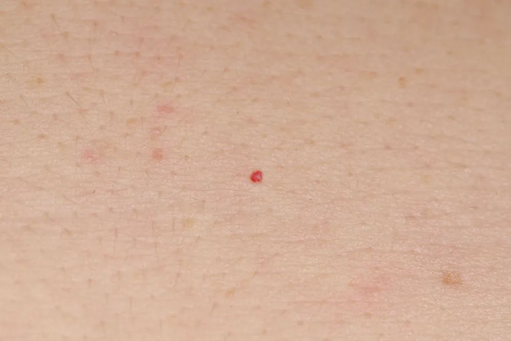 身上突然长了很多红点怎么回事,身上突然长很多小红点是什么原因