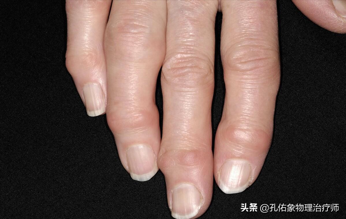 手指发胀捏不拢拳是什么原因,手指发胀不灵活咋回事