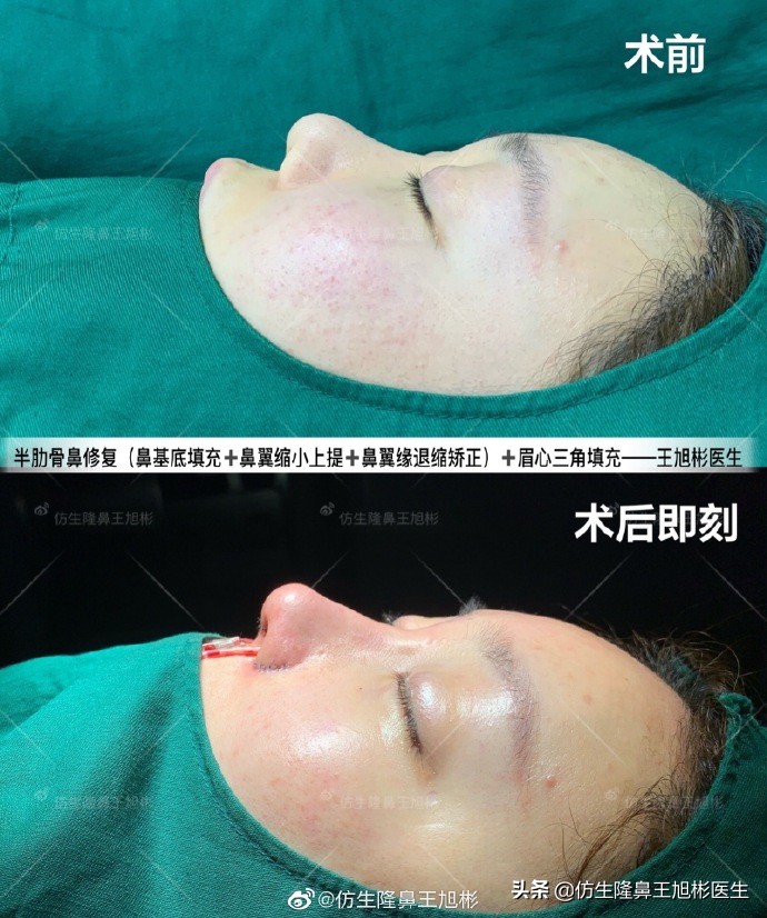 隆鼻鼻型科普,鼻基底凹陷隆鼻可以改善吗