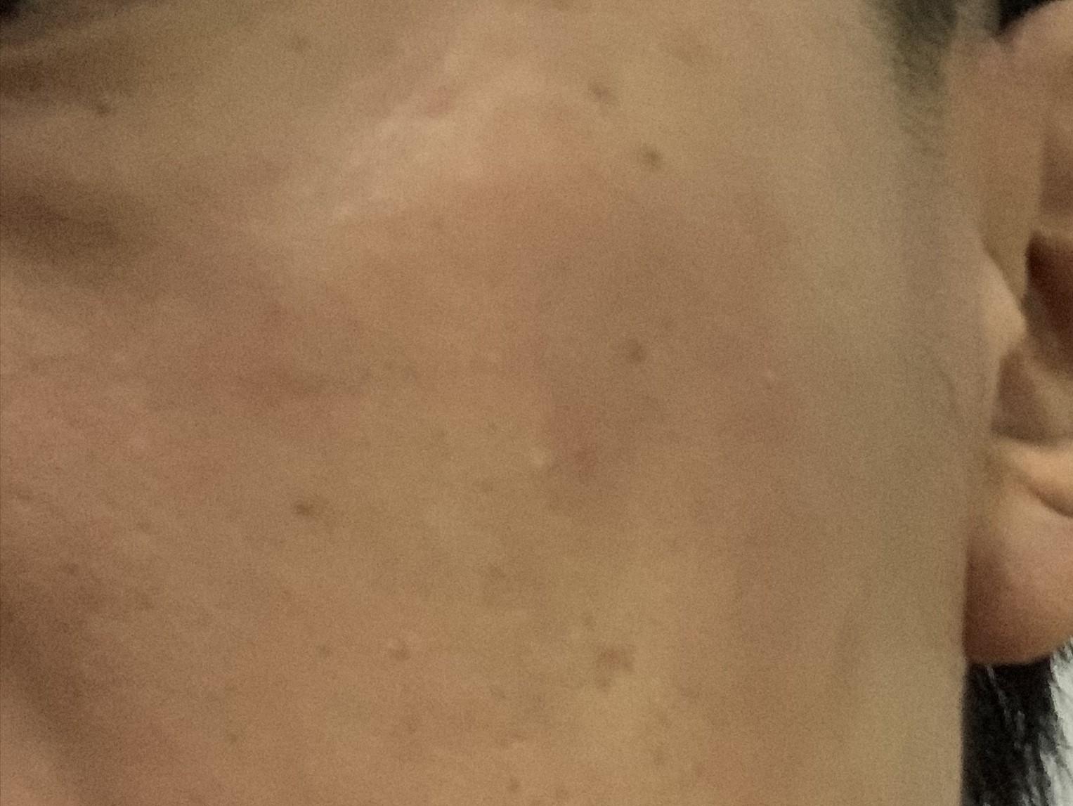 17岁女儿脸上长很多痘痘粉刺,12岁女儿脸上长满痘痘怎么办