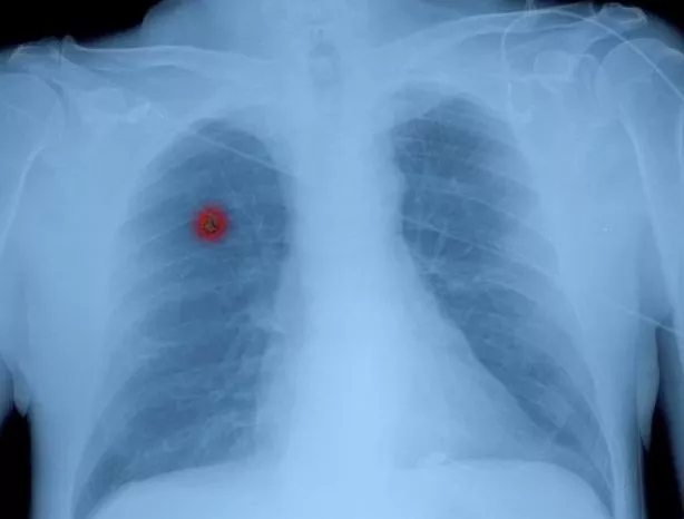 磨玻璃结节4mm有血管穿行要手术吗,磨玻璃结节7mm手术费用大概多少钱