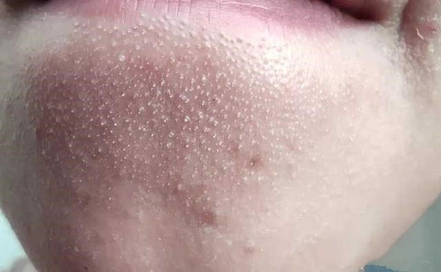 如何有效的去角质,去角质方法长期不去角质会怎样