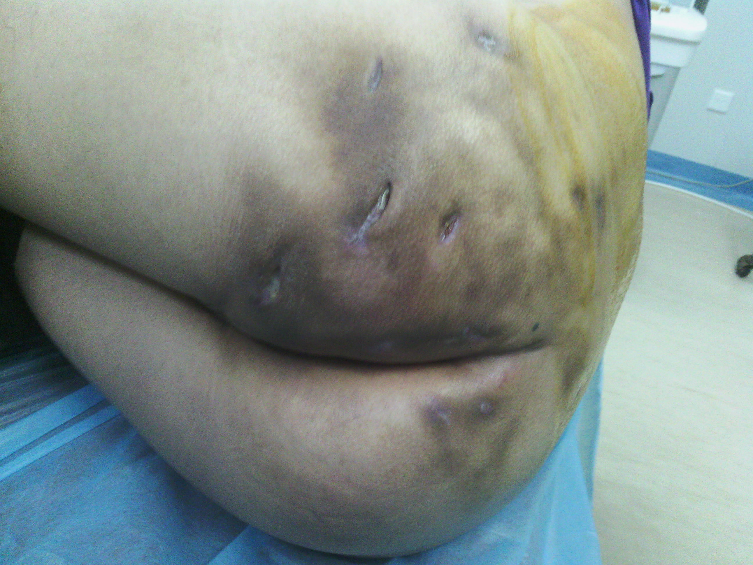 屁股痤疮最怕的克星,屁股痛的克星