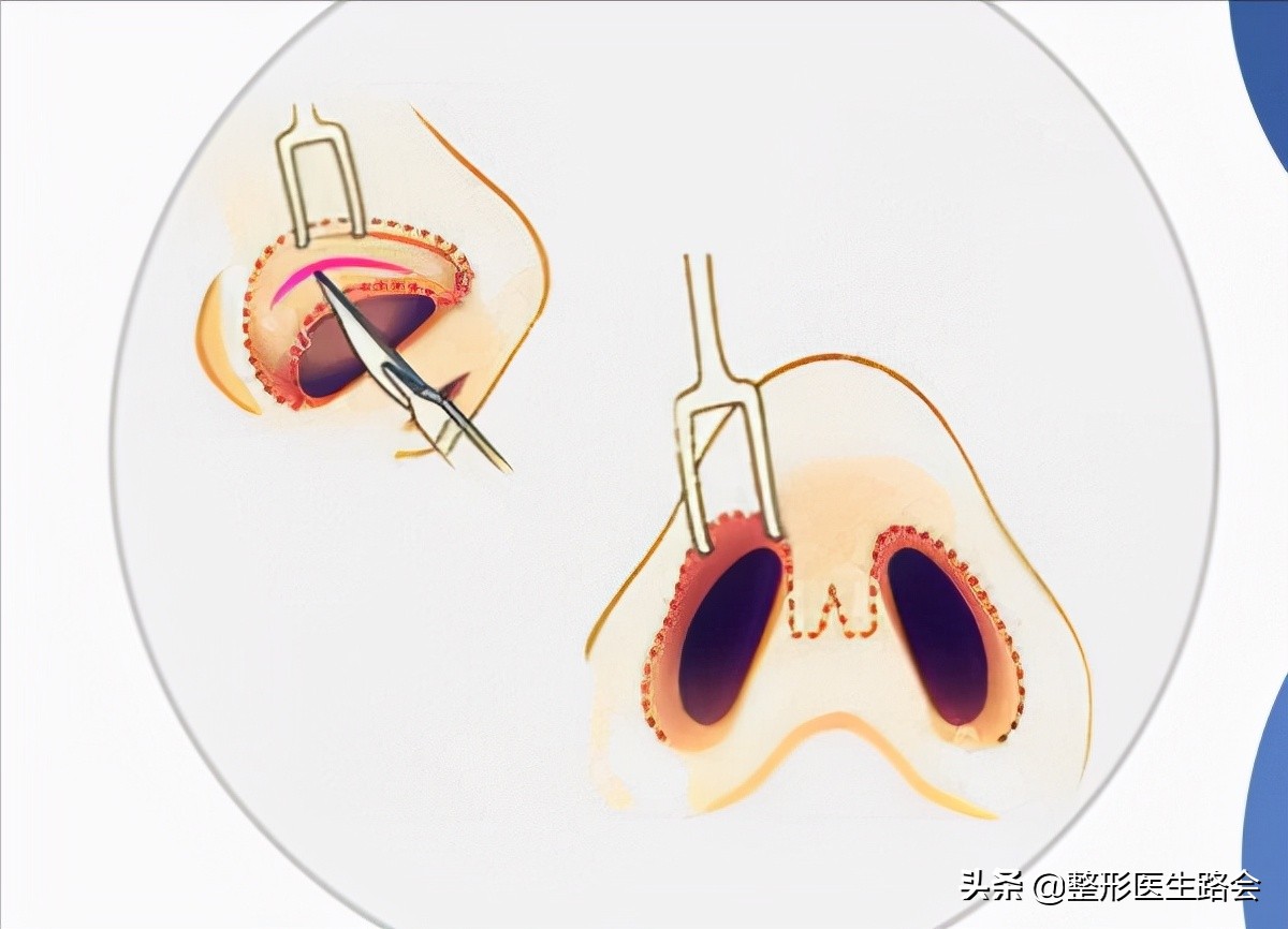 韩式隆鼻是不是就是单纯隆鼻,韩式隆鼻一般要多少钱一次案例
