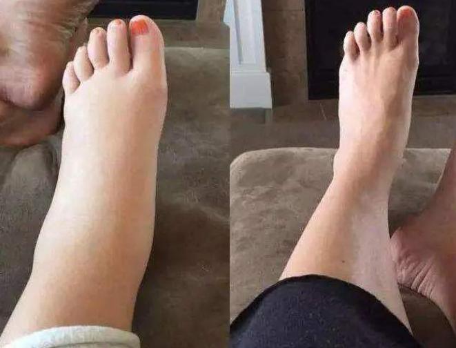 孕期脚肿是好还是不好,脚肿的和馒头一样大