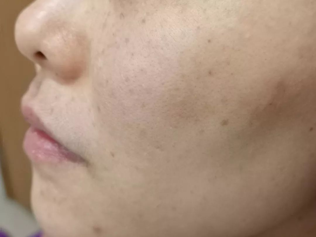 雀斑样痣是雀斑的一种吗,雀斑痣和健康痣有什么区别