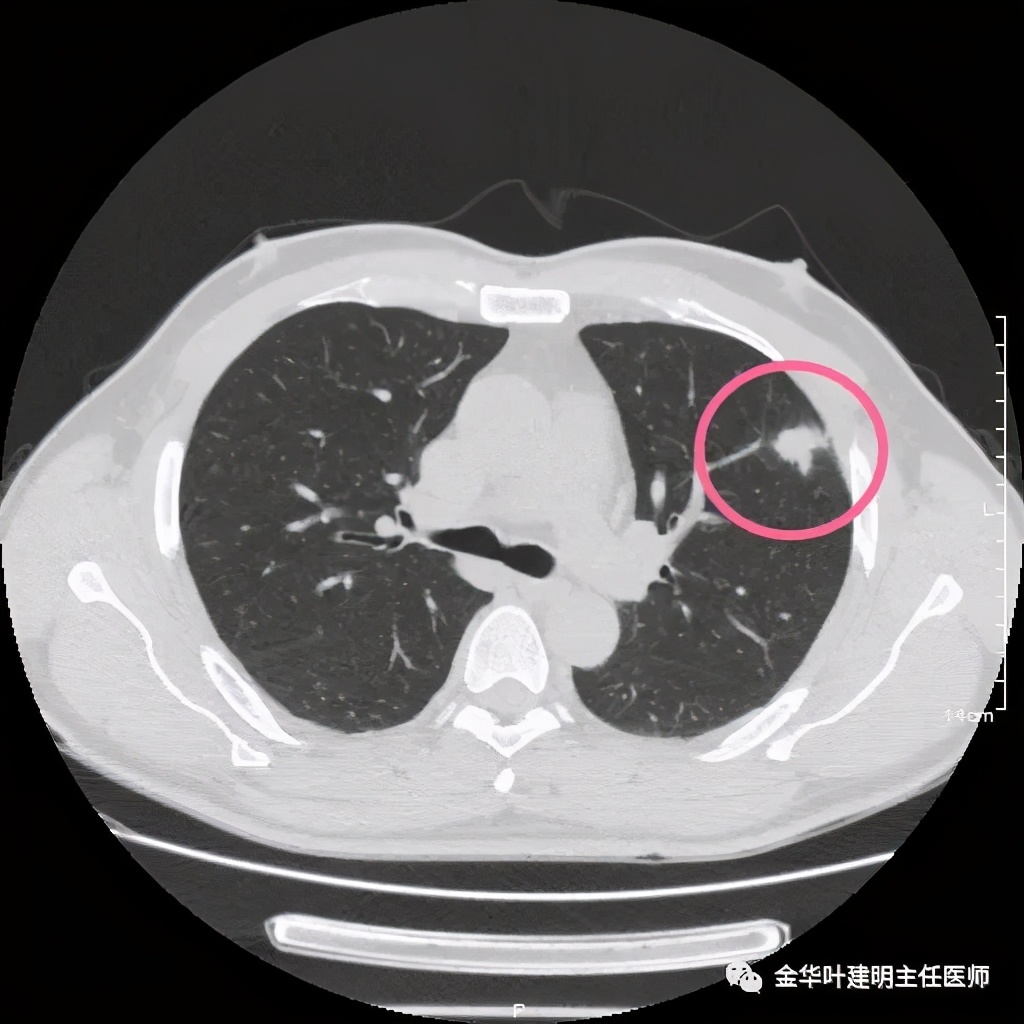 叶建明谈肺结节:一招分辨隐球菌性肉芽肿与肺癌